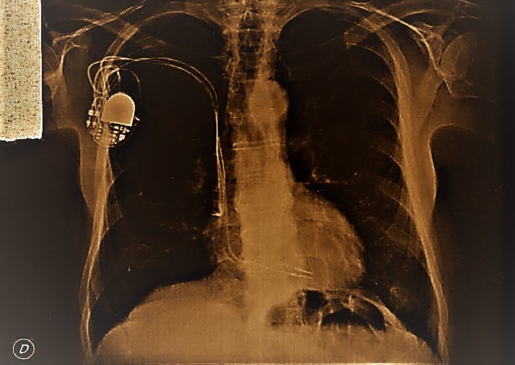 "radiografa de un marcapasos" de Valentn Rizzi